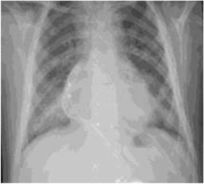 trisomy 21 List of Frontiers open access articles